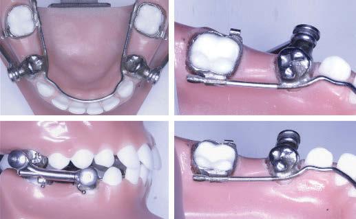The key to each plan was that the lower incisor position was not compromised, and a solid Class III molar was achieved with a high probability that the mandibular third molar would erupt into