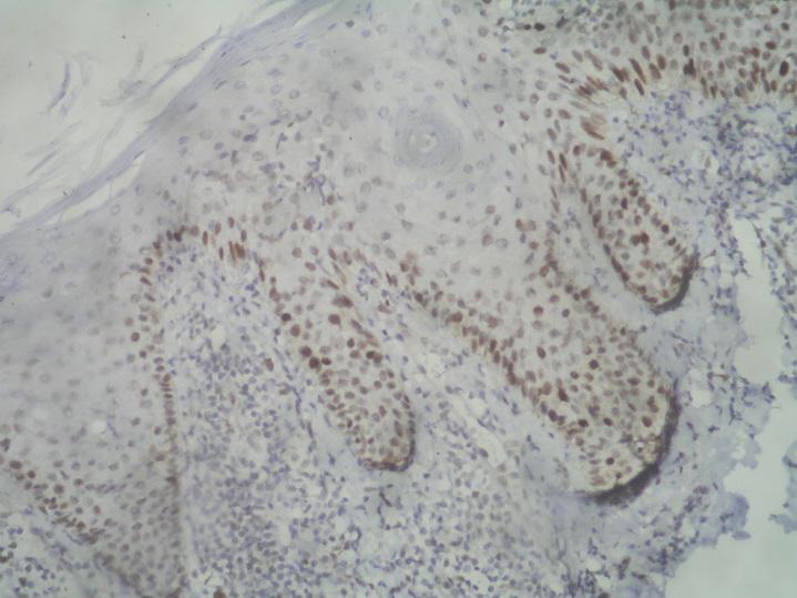 immunostain at of methotrexate therapy (200X).