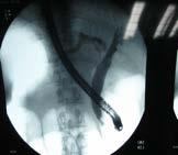 ERCP showing biliary
