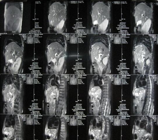 Image 4. MRCP with multiple liver cysts.