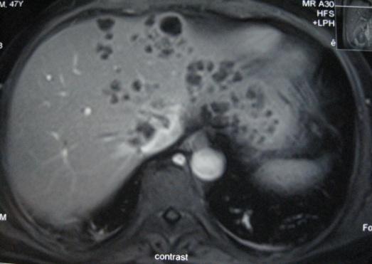 MRI showing multiple liver cysts in one