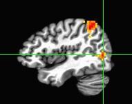 Fixation Durations: Words Positive correlation in the occipito-temporal junction, intraparietal sulcus, and
