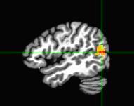 Fixation Duration: Non-Words Positive correlation in the occipito-temporal junction
