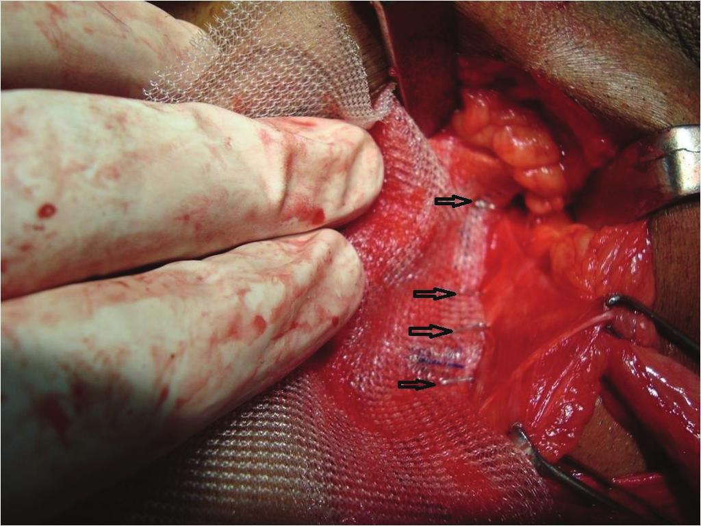 2 Surgery Research and Practice Figure 1: Arrow head showing staples along the inguinal ligament.
