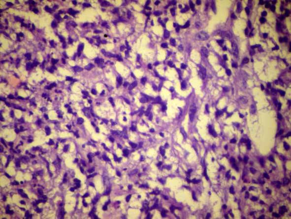 Histological features of lepra reactions 61 Figure 7. Biopsy during reaction. Macrophage granuloma with neutrophil infiltration. BL with T2R, H and E, X400.