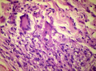 In addition to this, three histological patterns were observed in our patients (Table 3).