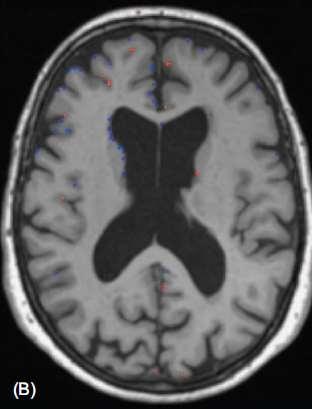 Atrophy rate was 2.50% per year. Atrophy most strongly appears here as enlargement of the ventricles.