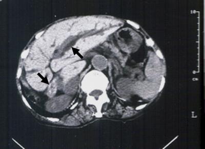 diagnosis of acute cholangitis with obstructive jaundice was made, and intrabiliary Figure 1 Figure 1: Abdominal computed tomography (CT) showed a dilated intrahepatic duct and lesions with