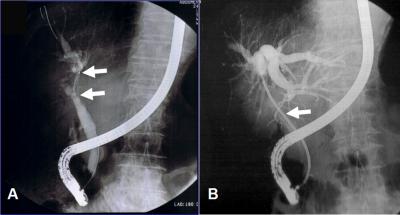 Figure 3 Figure 5 Figure 3: Endoscopic retrograde cholangiography (ERC) showed bile duct obstruction (A) and bile duct stenting (plastic stent; 8.5Fr, 12 cm; B) ().