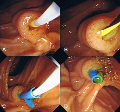 ERC was performed for cannulation into an orifice of Vater s papilla (A), exchange of a guidewire (B), and insertion of a bile duct stent (C, D). Figure 6 Table 1.