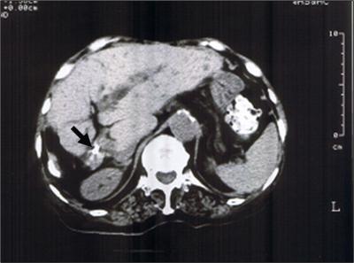 Intrabiliary rupture of a hepatic hydatid cyst is a common complication and may occur in 2 forms: an occult rupture, in which only the cystic fluid drains to the biliary tree and is observed in