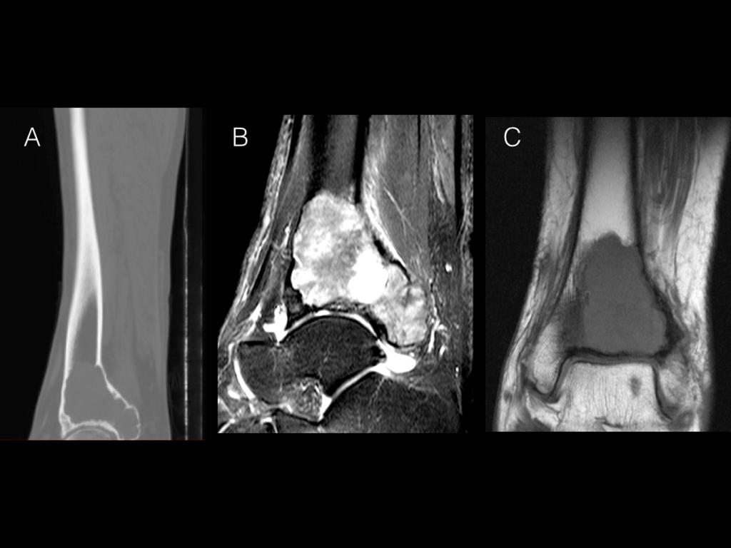 Fig. 6: Giant Cell tumor of the tibia. A) Coronal CT of the tibia showing an eccentric lytic lesion in the distal extremity of the tibia, abutting the articulation without a sclerotic border.