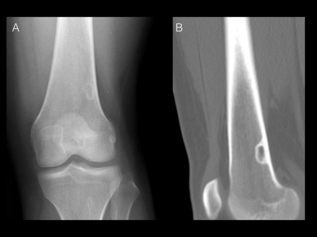 Fig. 7: Fibrous cortical defect of the distal femur. A) Anteroposterior radiogram of the knee. B) Coronal CT of the distal femur.