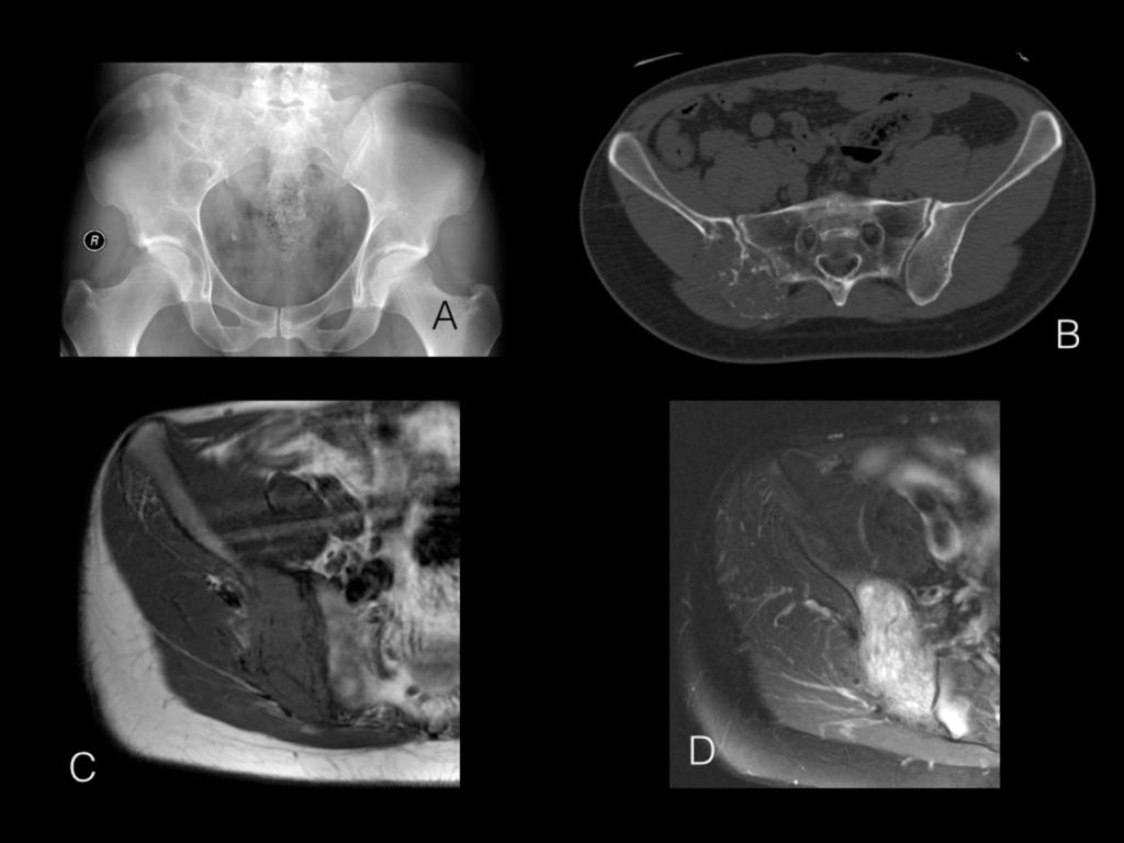 Fig. 9: Renal Cell Carcinoma metastasis of the pelvis.
