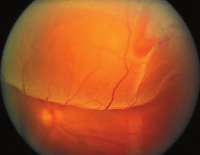 The retina is normally maintained in its attached position by many factors, but most importantly by a continued physiologic outward movement of fluid across the retinal pigment epithelium into the