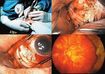 The new england journal of medicine A C Figure 3. Scleral Buckling Surgery for Retinal Detachment.