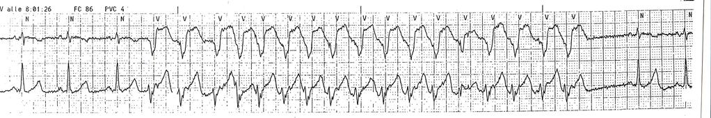 the more the arrhythmia s prevalence increases. The atrial fibrillation often represents a worsening cause for the heart failure, and this worsening, by itself, generates atrial fibrillation.