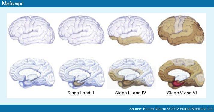 Different stages of tau deposition in Alzheimer's disease.
