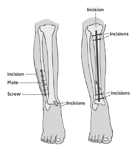 Internal fixation: - This involves stabilising the bones with either: n A plate placed directly on the bone, or n A special rod known as an intermedullary nail, which