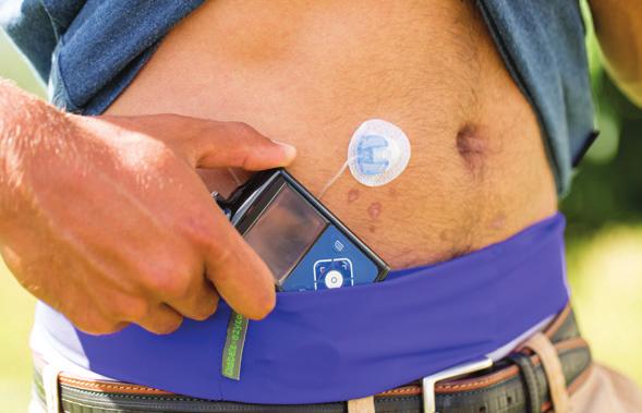 An insulin pump is a discreet electronic device, about the size of a small mobile phone.