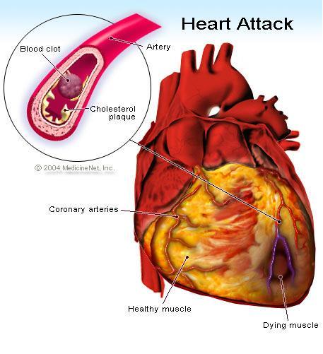 If a clot breaks free, it may flow to a coronary artery and block a blood
