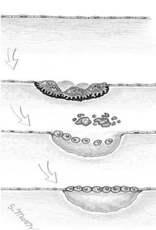 The Life Cycle of Bone Bone Lining Cells
