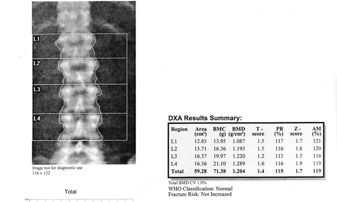 Diagnosis T-score WHO criteria Normal - > -1 Osteopenia - <-1 and >-2.5 Osteopororsis - <-2.