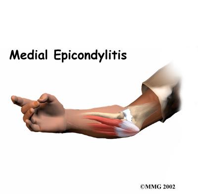 Introduction Medial epicondylitis is commonly known as golfer's elbow. This does not mean that only golfers have this condition. But the golf swing is a common cause of medial epicondylitis.