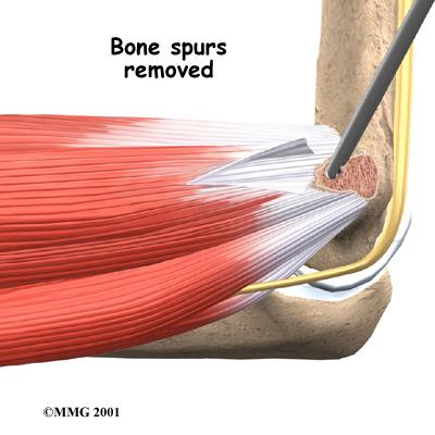 In these cases, the surgeon cleans up the tendon, removing only the damaged tissue. Tendon Release A commonly used surgery for golfer's elbow is called a medial epicondyle release.