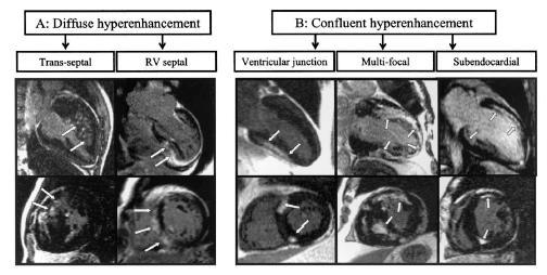 Delayed Enhancement in Hypertrophic Cardiomyopathy Diffuse Hyper enhancement Confluent Hyper enhancement Trans-septal