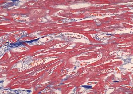 Delayed Enhancement in Hypertrophic Cardiomyopathy Heterogeneity of fibrosis in myocardial disease: Replacement fibrosis macroscopic scar microspic scar Plexiform fibrosis, associated
