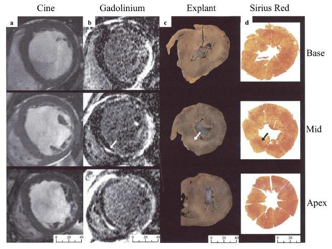 Delayed Enhancement in Hypertrophic Cardiomyopathy MRI with DE technique allows detection and