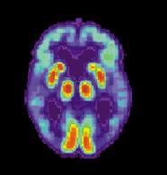 Alzheimer s Brain Note the