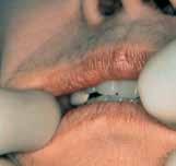 resorbed lower ridges may expose the frenulum to the pressure of