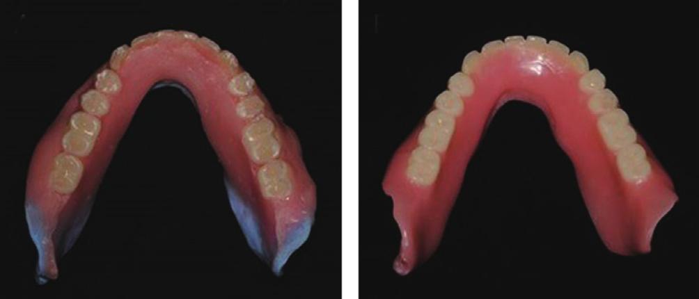Contour of lingual surface in lower complete denture formed by polished surface impression with those of the impression surface and occlusal surface.