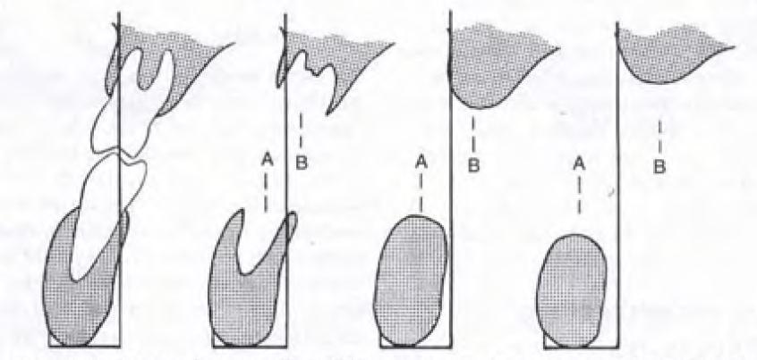 The maxilla resorb upward and inward to become smaller b/c of direction & inclination of roots of teeth &