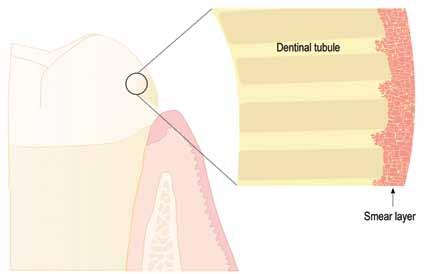 With dentin bonding, the etchant creates a demineralized surface 3 μm to 5μm in depth while also removing the smear layer debris created during instrumentation.
