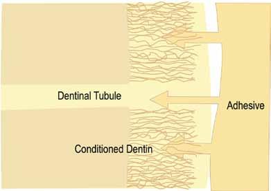 mineralized dentin within this microscopic etched surface and providing retention upon curing of the adhesive.