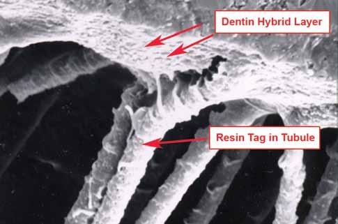 intertubular dentin (Figure 5). 15 Three-step etch-and-rinse systems contain an etchant, a primer, and a bonding resin (adhesive).
