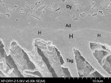 Figure 15. SEM of XP Bond applied to overdried dentin Dy = Dyract AD = Adhesive H = Hybrid Tag = Resin Tag H Image courtesy of Dr. Jorge Perdigão Figure 16.