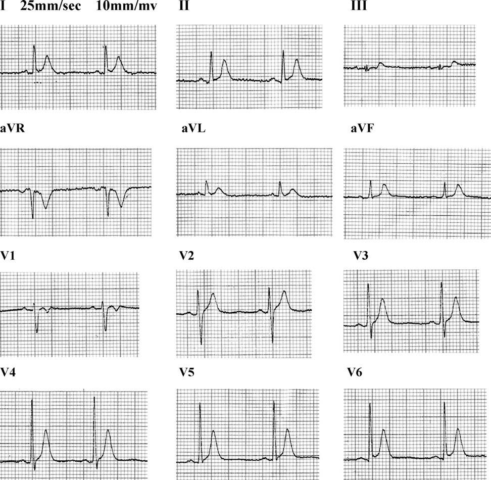 Short QT syndrome 117 Figure 2 Twelve-lead electrocardiogram. she did not have any further episodes of ventricular tachycardia.