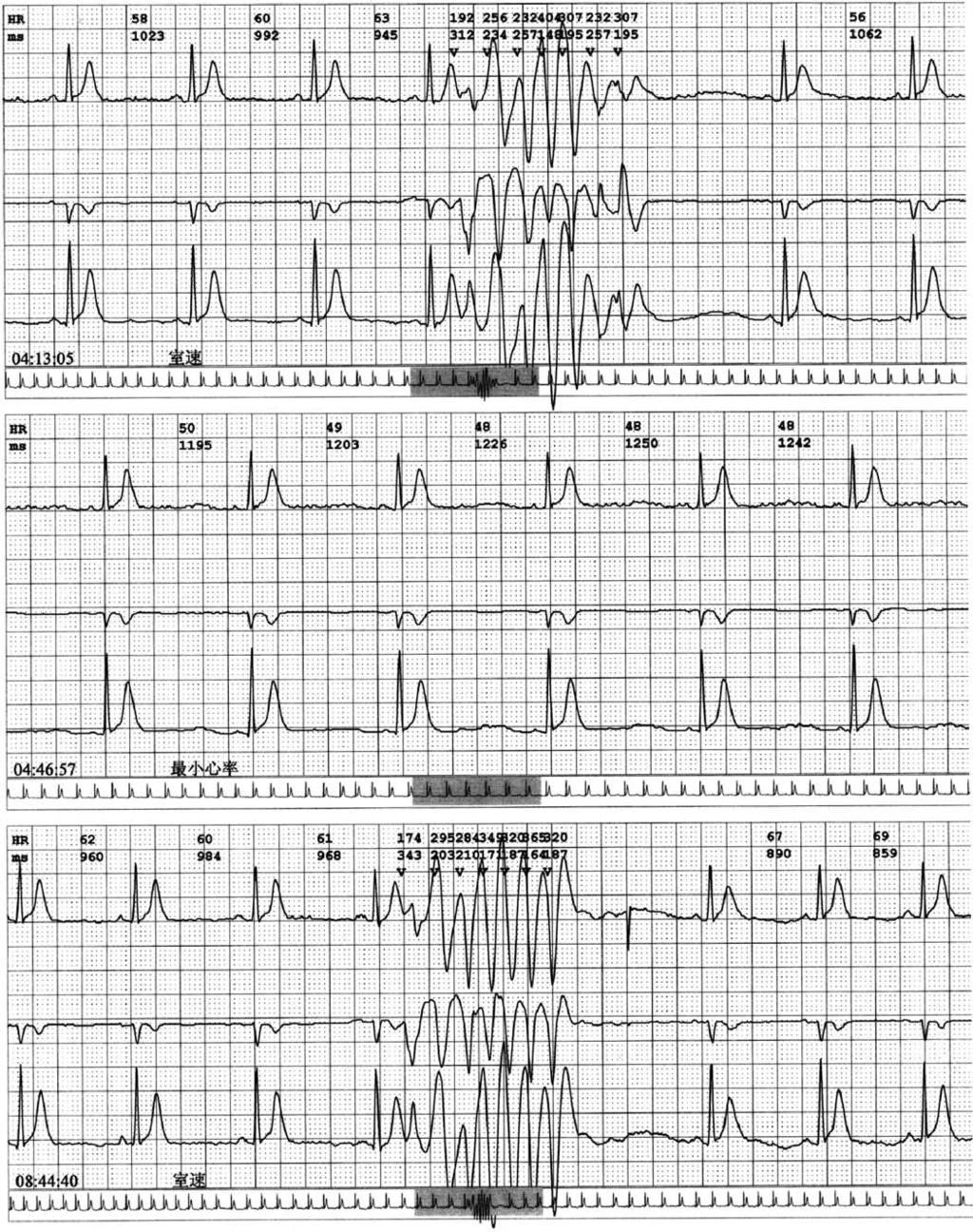 118 L.X. Lu et al. Figure 3 Holter monitoring showed self-terminating polymorphic ventricular tachycardia and short QT interval.