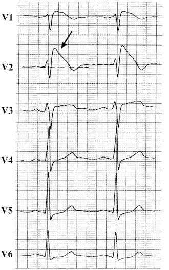 ventricular arrhythmias ECG