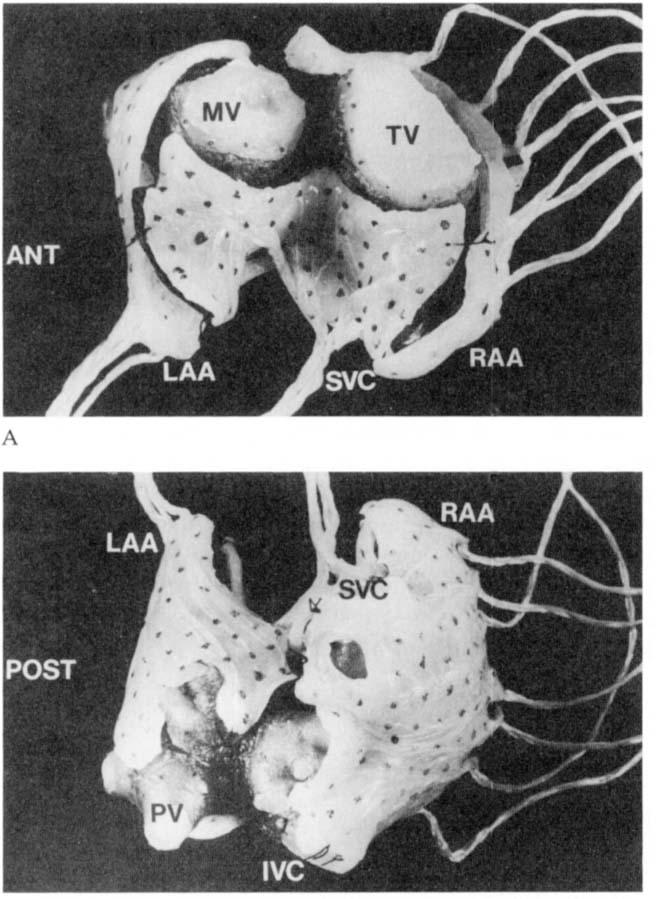 Two templates are used to cover the posterior surface On the posterior left atrium, a template extends from the A under the pulmonary veins (PV) to the inferior vena cava (IVC).