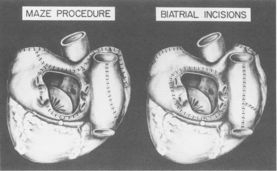 342 YAMAUCHI ET AL OPETION FOR ATRIAL FLUTTER 1993:56:33742 Fig 6. An anatomic drawing of the biatrial incision used to prevent the inducibility of atrial flutter is shown in the right panel.