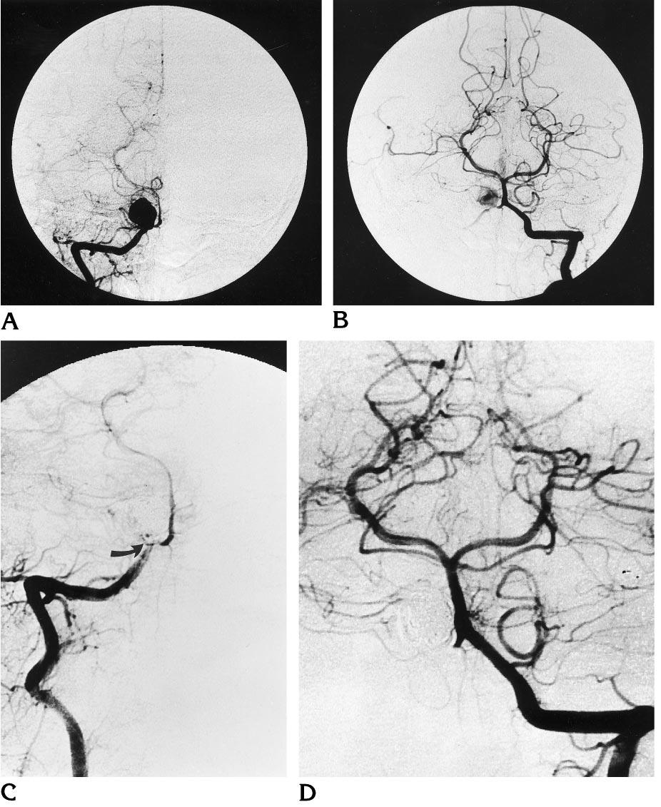 AJNR: 17, October 1996 INTRACRANIAL ANEURYSMS 1653 Fig 2. Aneurysm of the posterior inferior cerebellar artery (PICA).