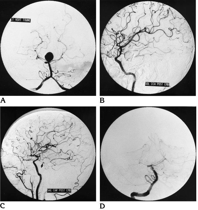 AJNR: 17, October 1996 INTRACRANIAL ANEURYSMS 1655 Fig 5. A, Anteroposterior vertebral angiogram before embolization shows aneurysms in the basilar tip and right superior cerebellar artery.