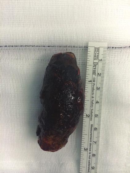 A primary sideto-side stapled anastomosis was performed. Due to the degree of inflammation around the gallbladder and duodenum a complete cholecystectomy was not performed.