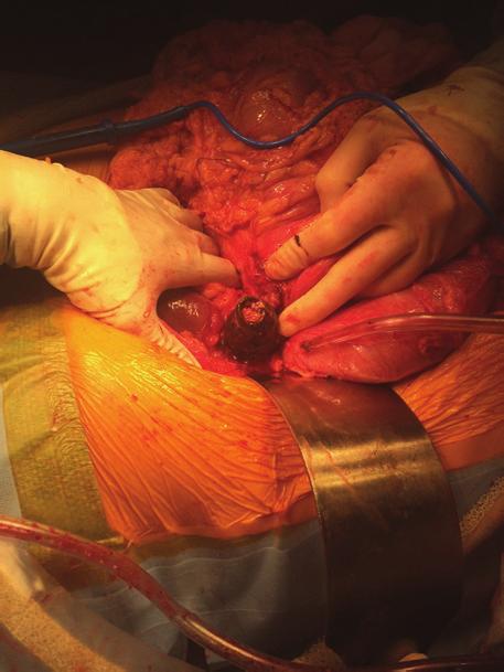 Five millilitres of sterile water was inflated into the Foley catheter balloon, and a purse-string suture was used on the gallbladder wall around the catheter to hold the balloon in the