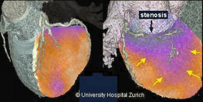 3D SPECT/CT imaging: stenosis of proximal